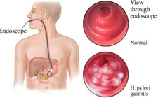 Gastrit Tedavisi Gastrit Nasıl Tedavi Edilir?