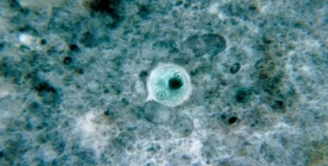 Amip Tedavisi Amip Nasıl Tedavi Edilir?