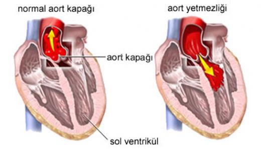 Kalp Yetmezliği Tedavisi Kalp Yetmezliği Nasıl Tedavi Edilir